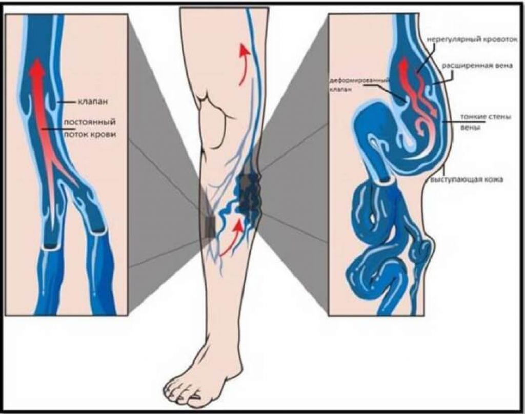 Варикоз Болят Ноги Что Делать