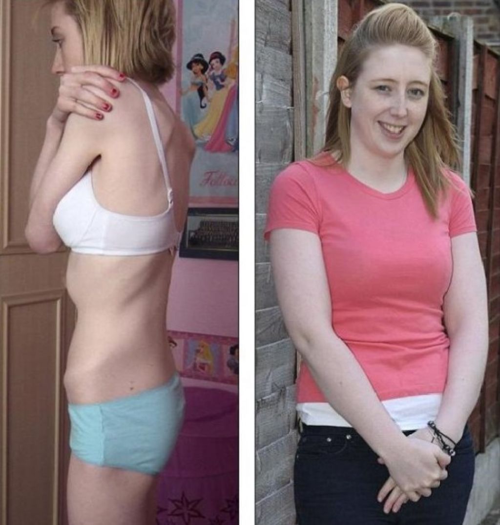 Анорексия фото до и после