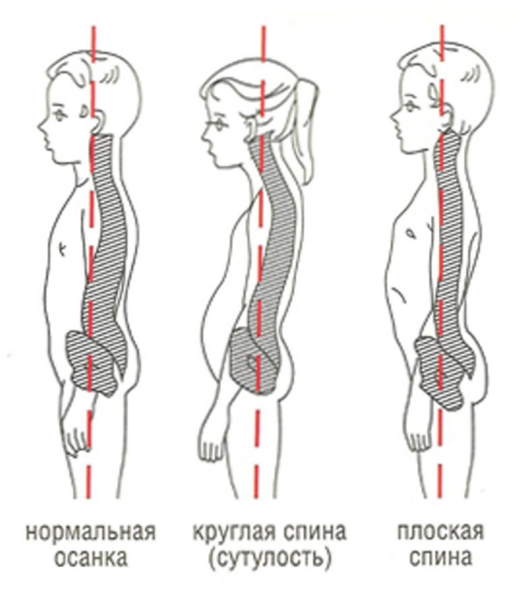 Гиперлордоз у детей фото