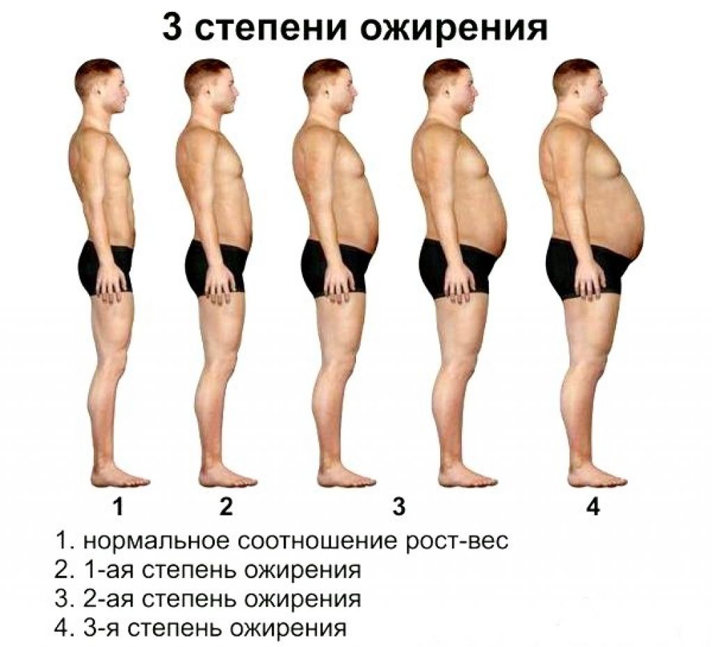 Какие бывают ожирения. Ожирение 3 степени у мужчин. Ожирение 1 степени у мужчин. 1 Стадия ожирения у мужчин. Ожирение 1 2 3 степени у женщин.