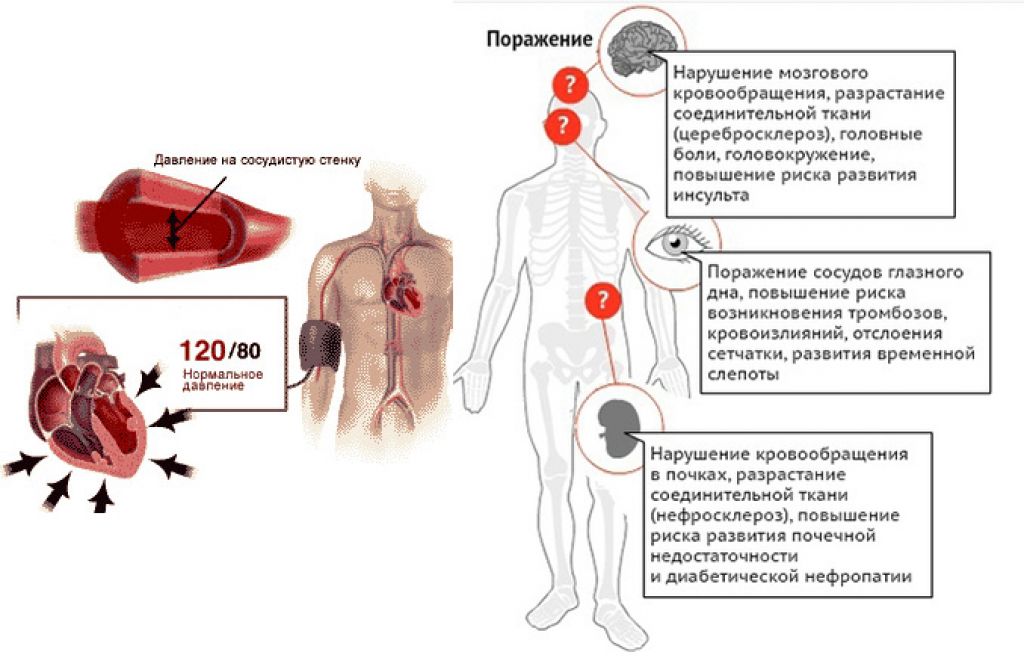 Где болит при высоком давлении. Гипертония. Наиболее поражаемые сосуды при гипертонической болезни. Нарушение артериального кровотока. Высокое давление.