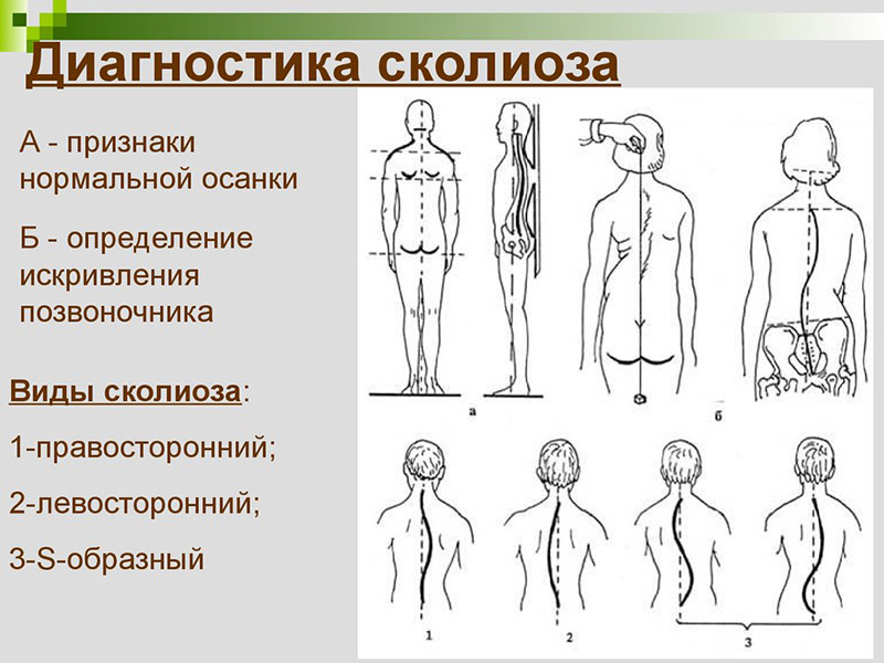 Матрас при сколиозе у подростка