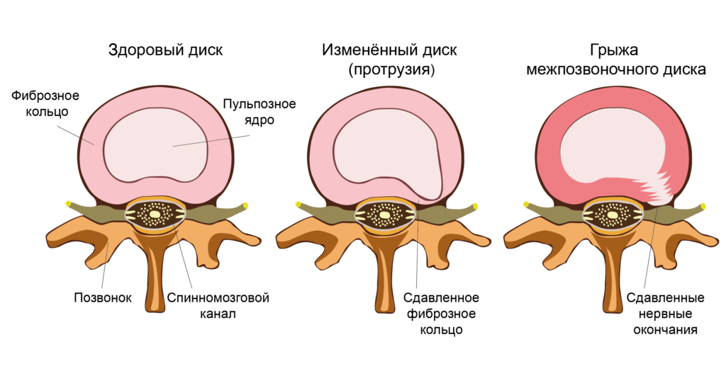 Грыжа межпозвонковых дисков презентация