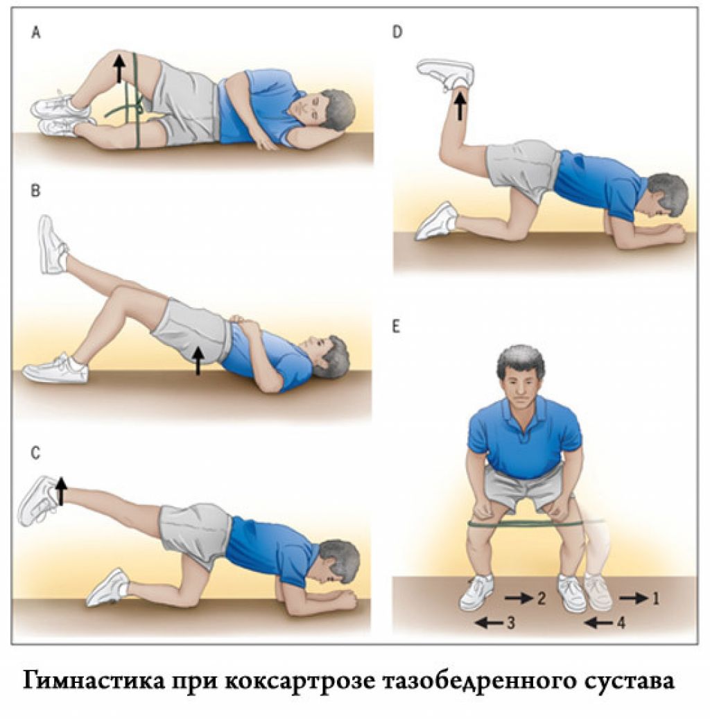 Лечение воспаление мышц тазобедренного сустава. Коксартроз тазобедренного сустава лечебная физкультура. Упражнения (гимнастика) при артрозе тазобедренного сустава. Упражнения для тазобедренного сустава при коксартрозе 1 степени. Упражнения при артрозе тазобедренного сустава 2 стадии.