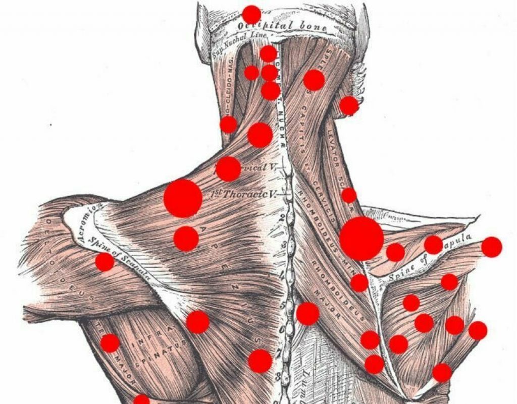 Миофасциальный синдром триггерные точки