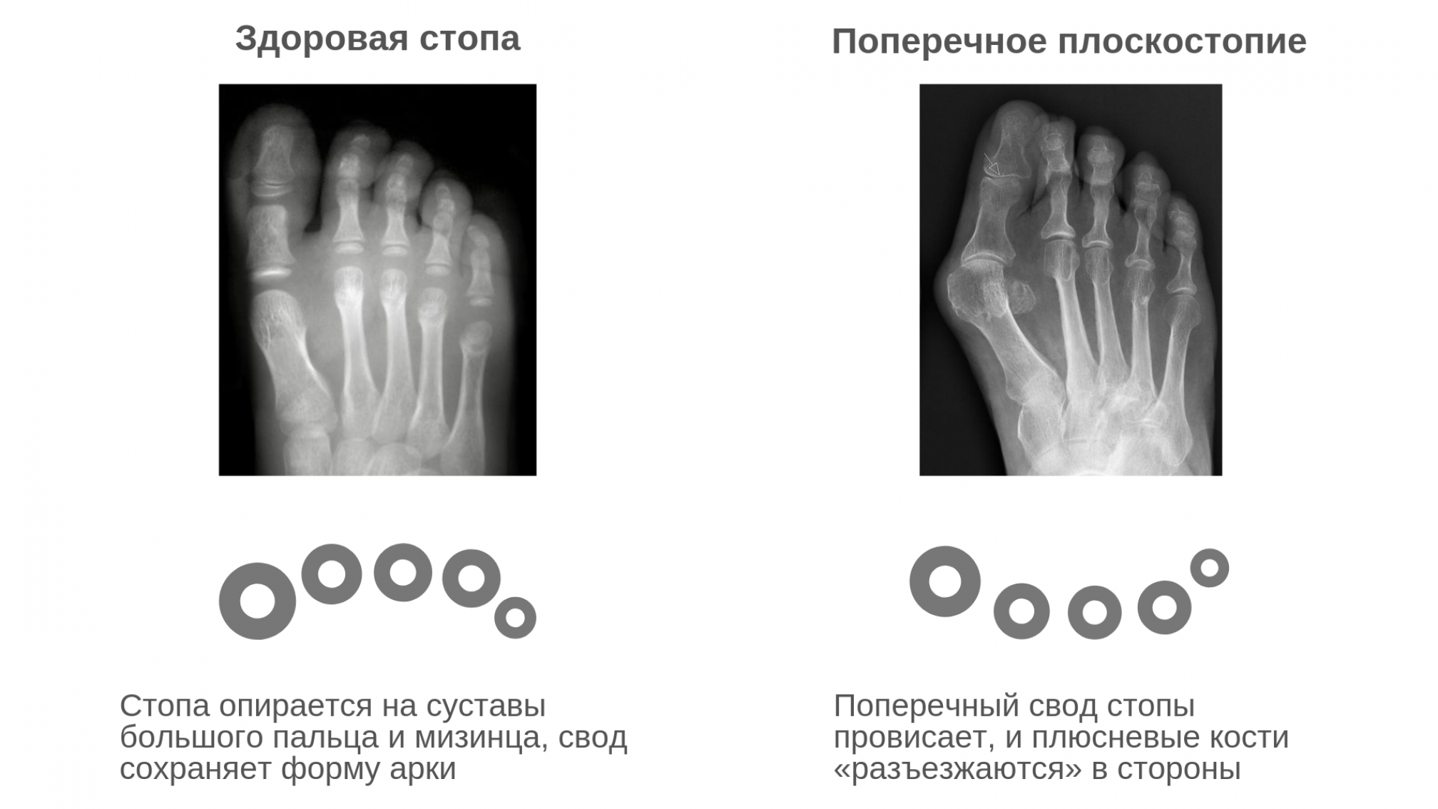 Поперечное плоскостопие - это как?