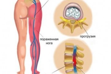 Упражнения для прокачки нижней части трапеции