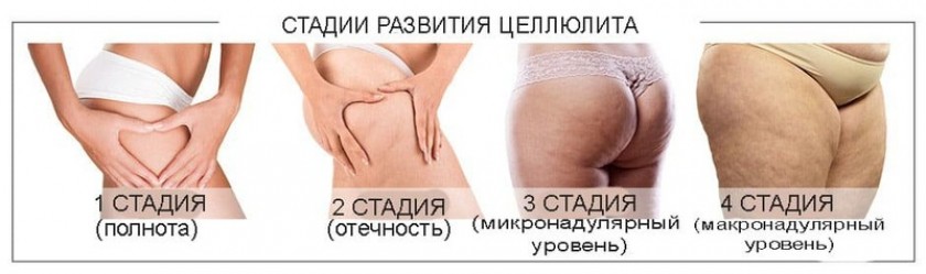 Как определить стадию целлюлита?