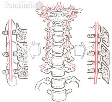 Ущемление артерий и вертебробазилярная недостаточность