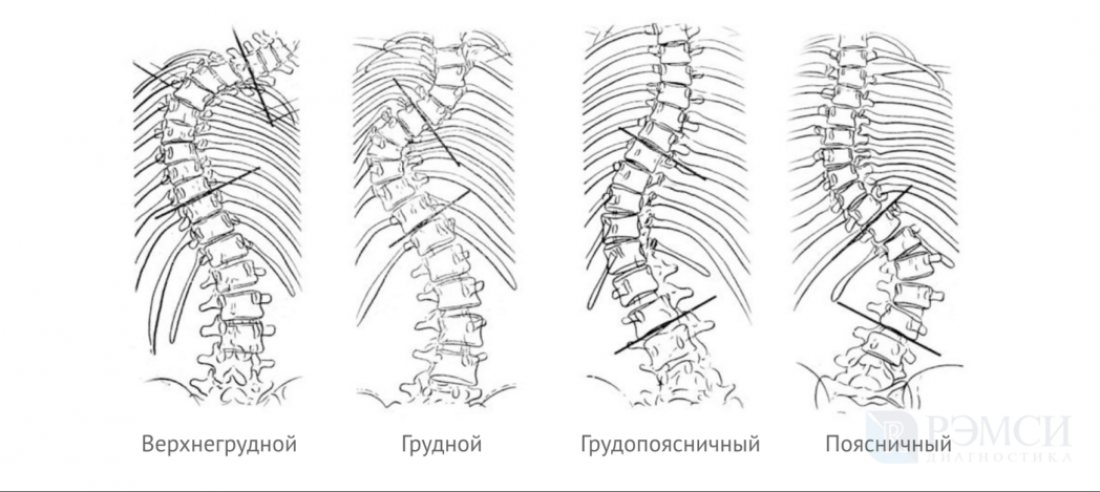 Симптомы различных видов сколиоза грудного отдела