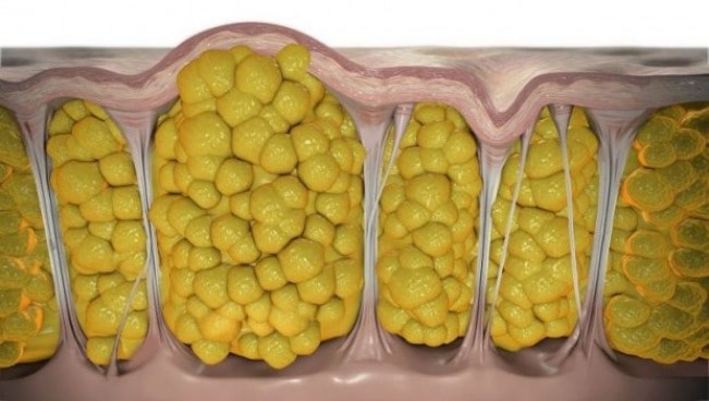Почему появляется целлюлит